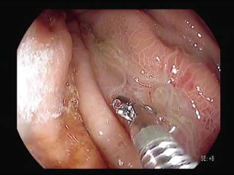 アニサキスに寄生された時の症状は